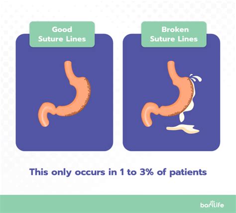 gastric sleeve leak|Endoscopic Management of Laparoscopic Gastric Sleeve Leaks